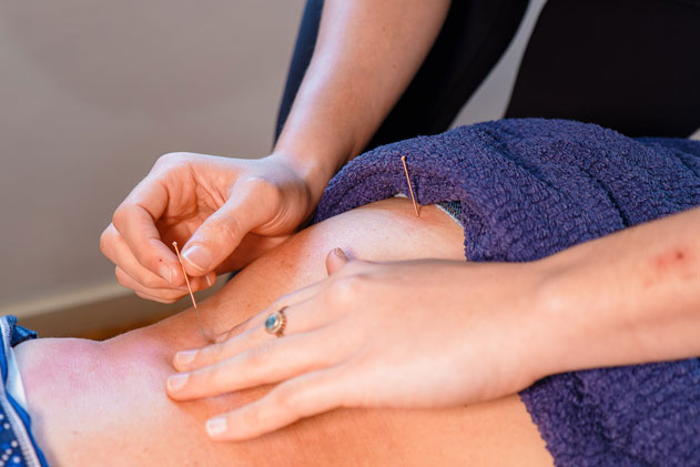 A woman receiving acupuncture treatment on her abdomen